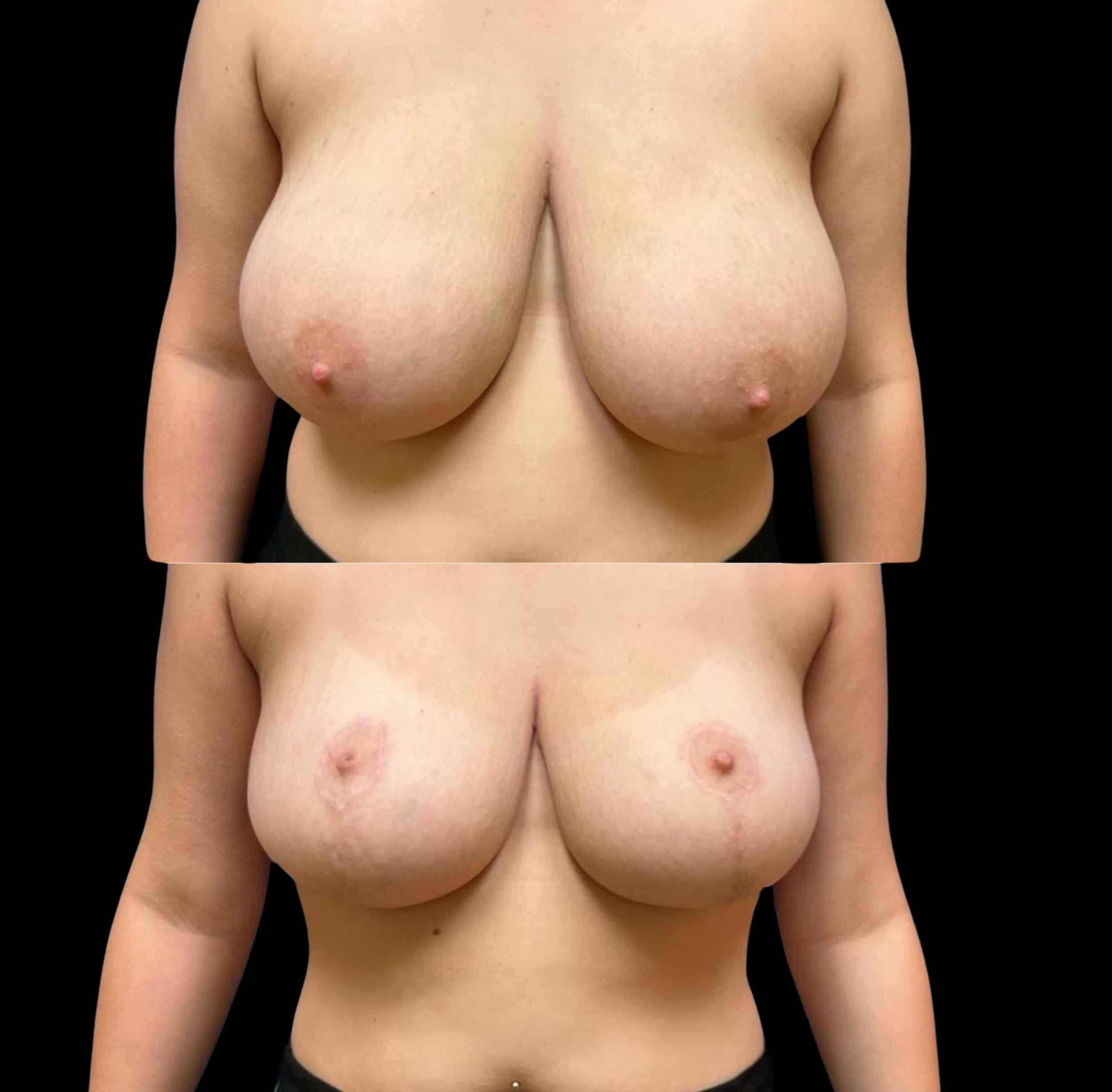 Before and After Image: Bilateral Breast Reduction
