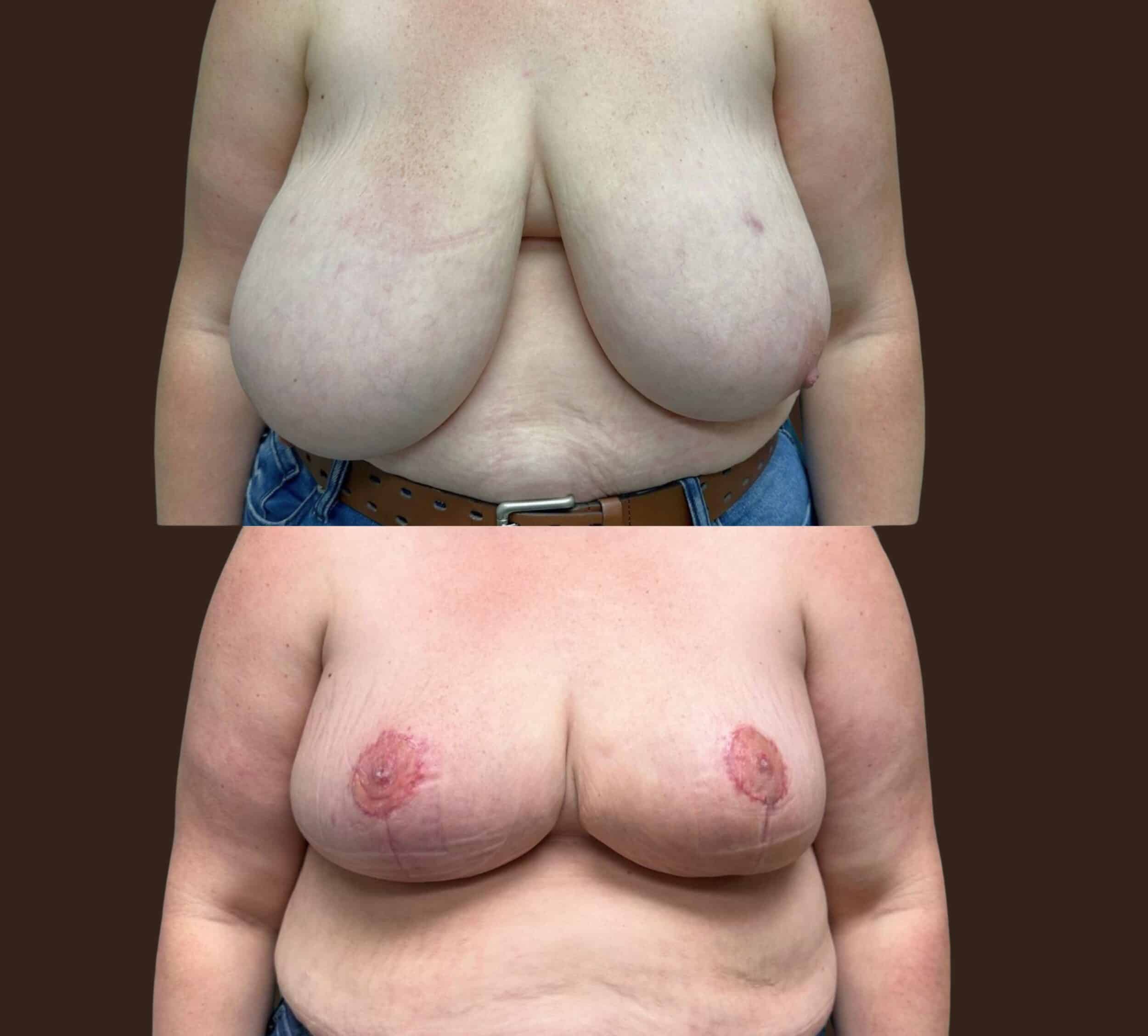 Before and After Image: Bilateral Breast Reduction with Nipple Grafting - front