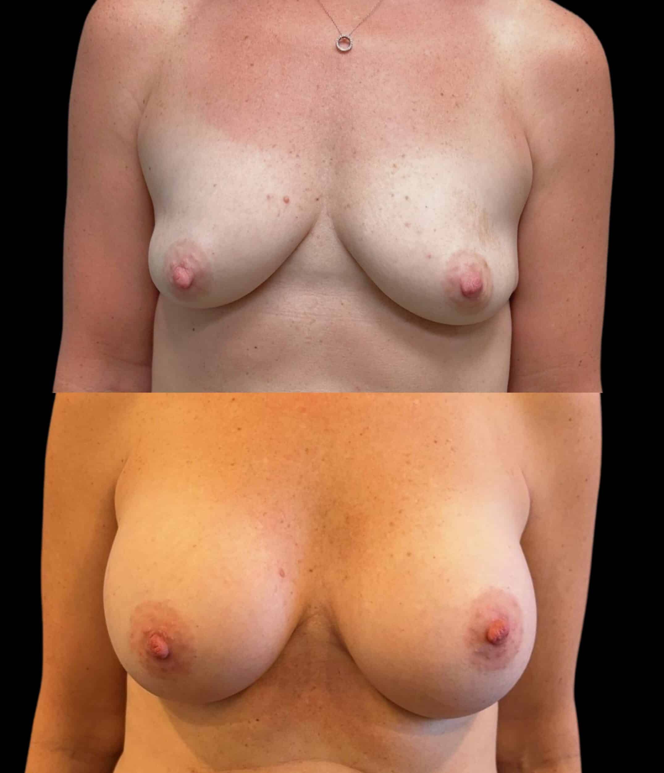 Before and After Image: Bilateral Breast Augmentation