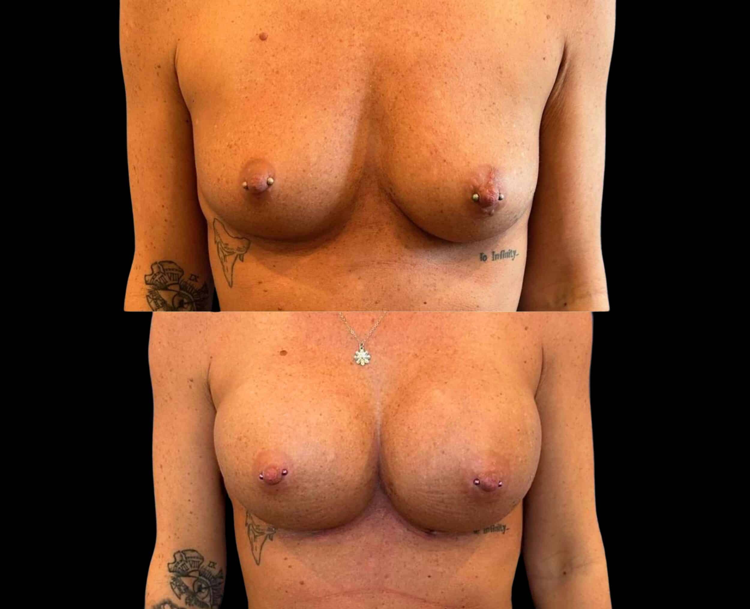 Before and After Image: Bilateral Breast Augmentation - front