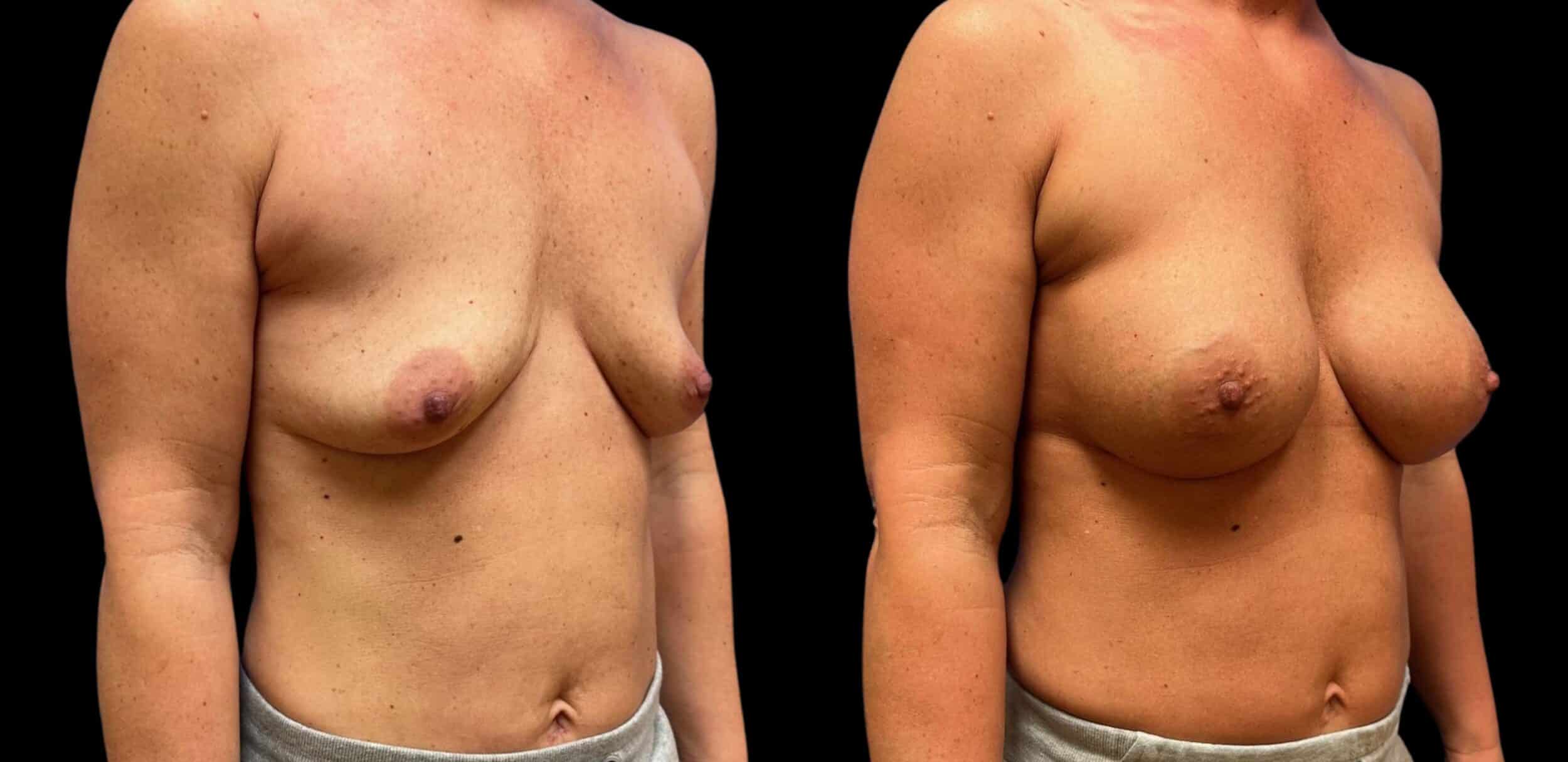 Before and After Image: Bilateral Breast Augmentation - right-front-oblique