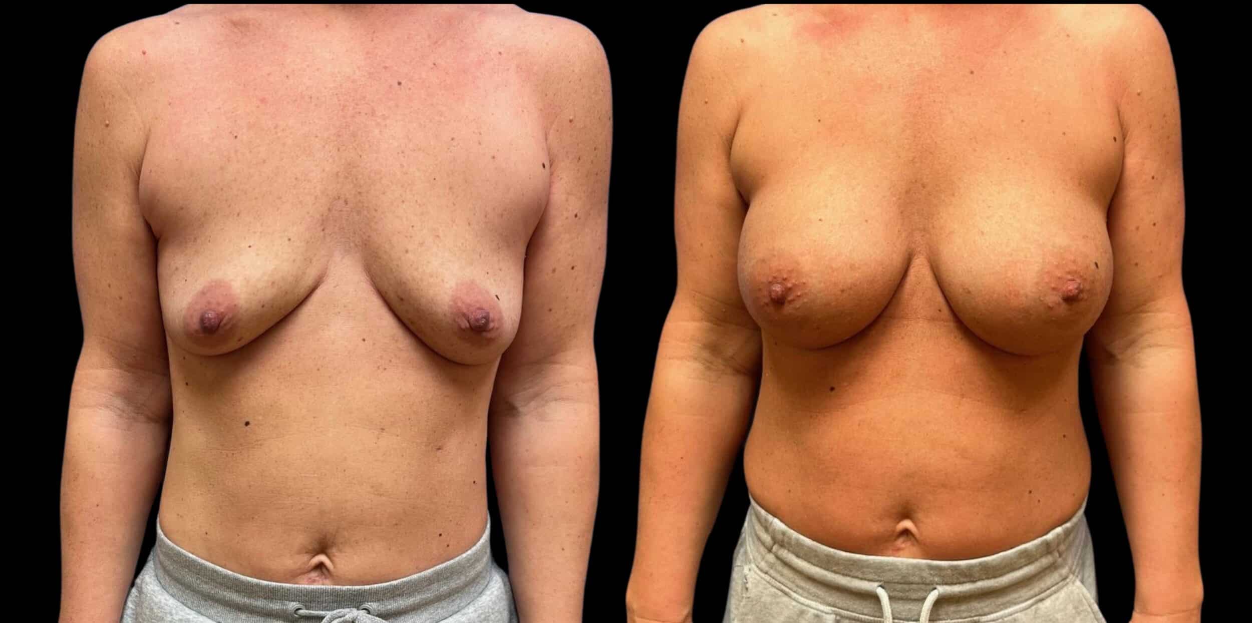 Before and After Image: Bilateral Breast Augmentation - front