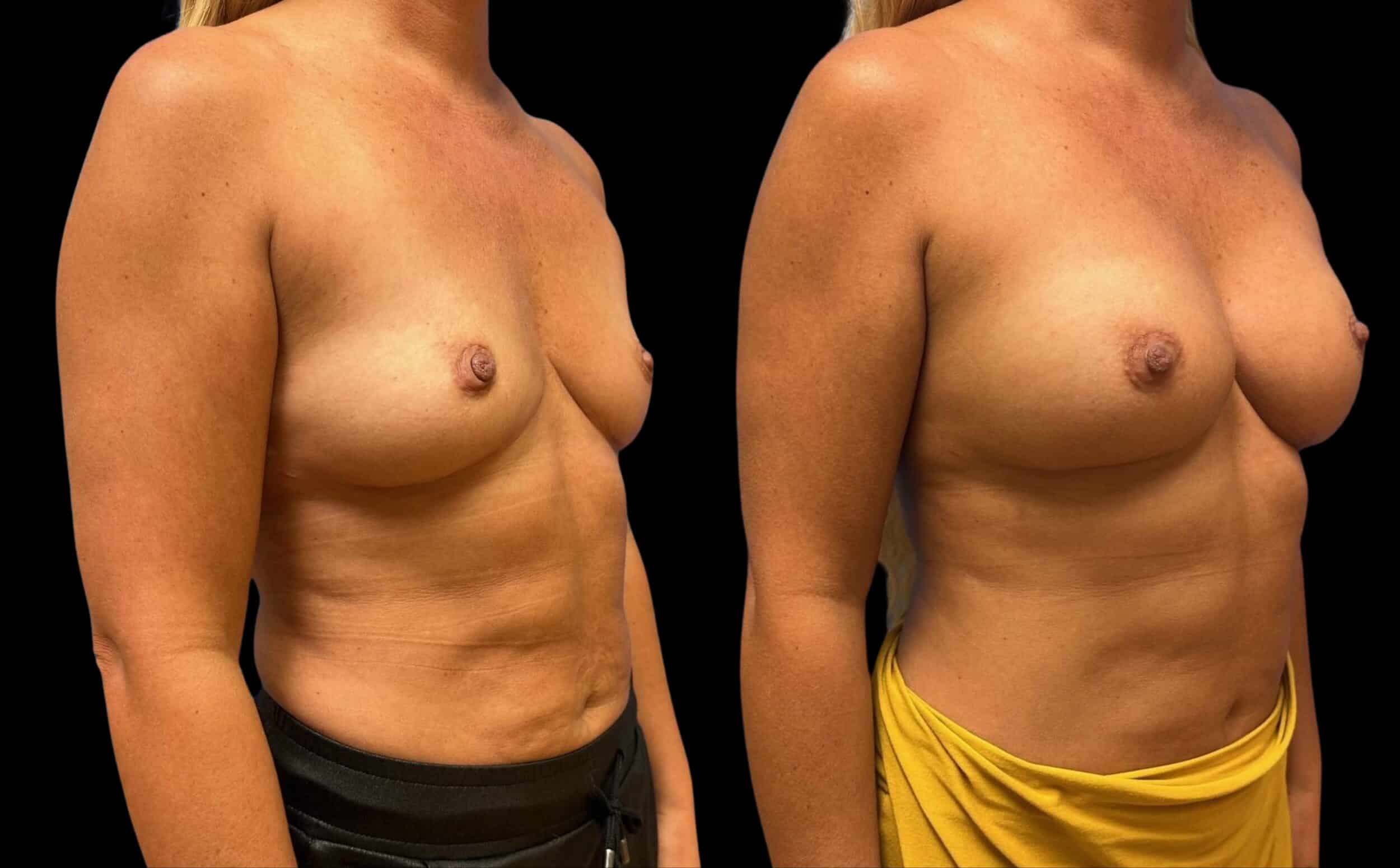Before and After Image: Bilateral Breast Augmentation - right-front-oblique