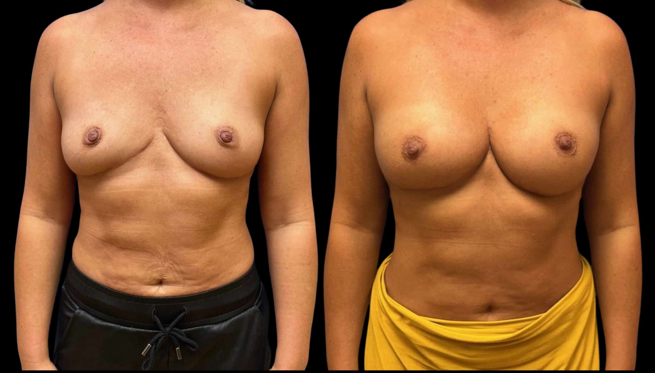 Before and After Image: Bilateral Breast Augmentation - front
