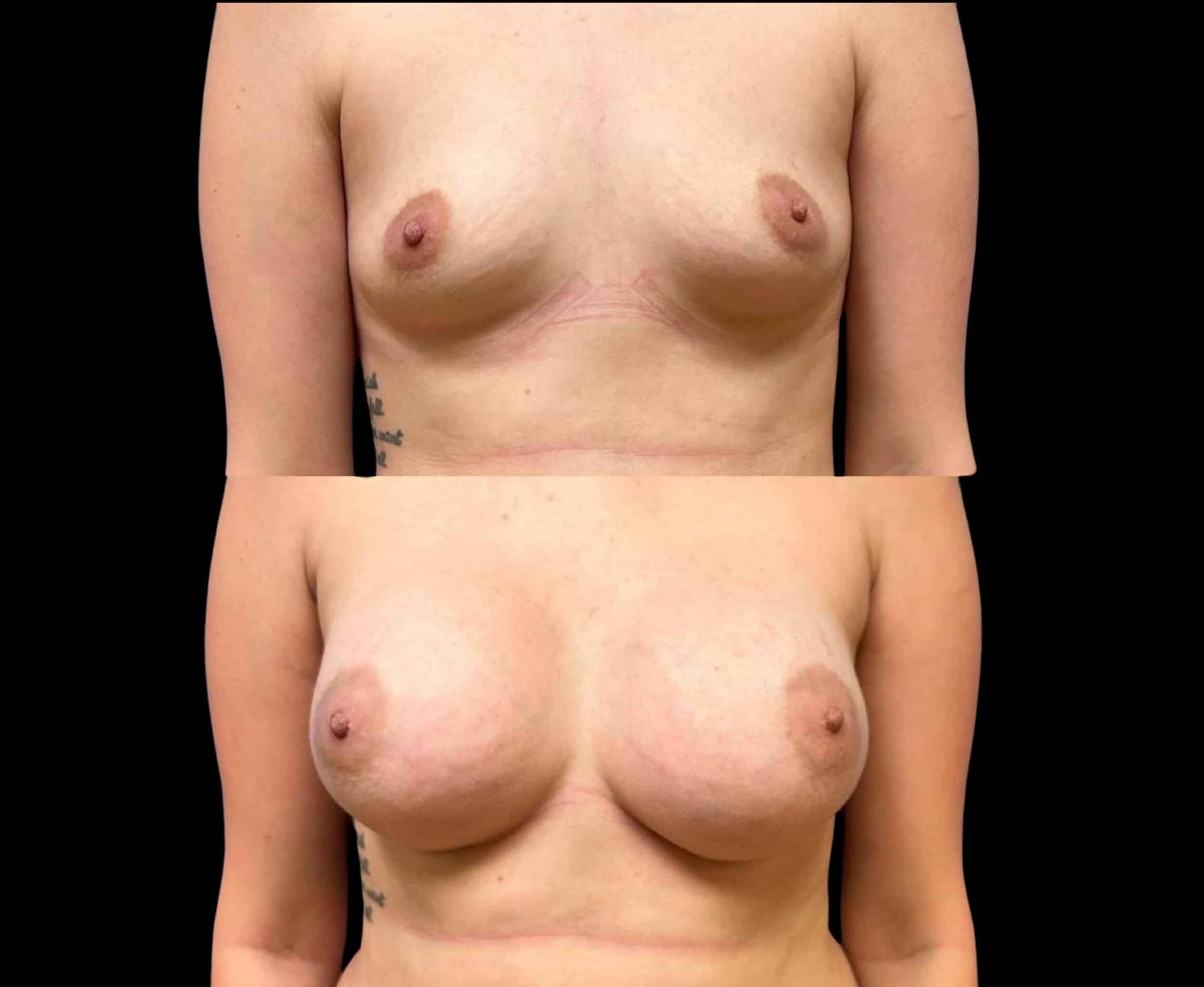 Before and After Image: Bilateral Breast Augmentation - front
