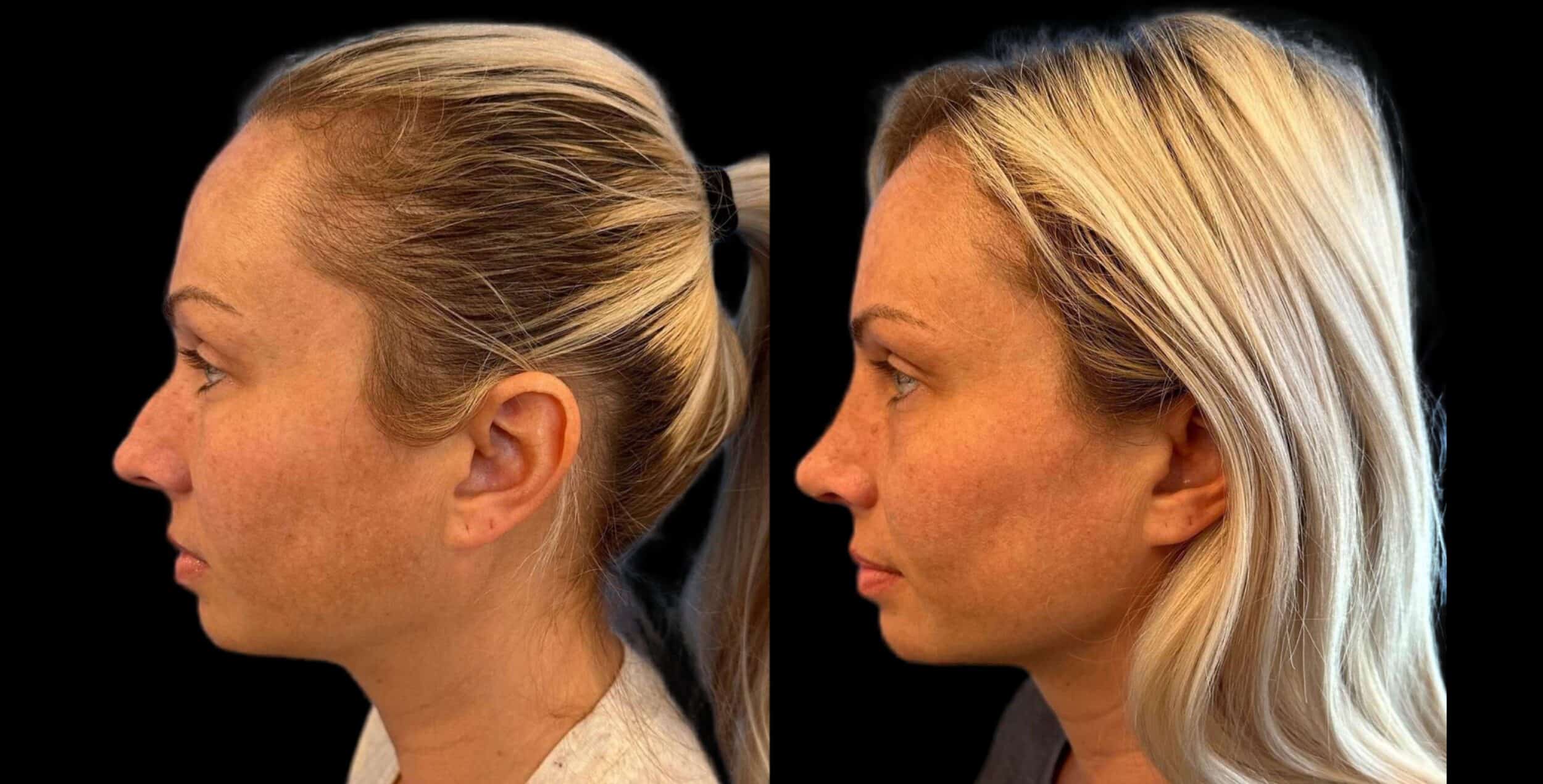 Before and After Image: Rhinoplasty - left-side