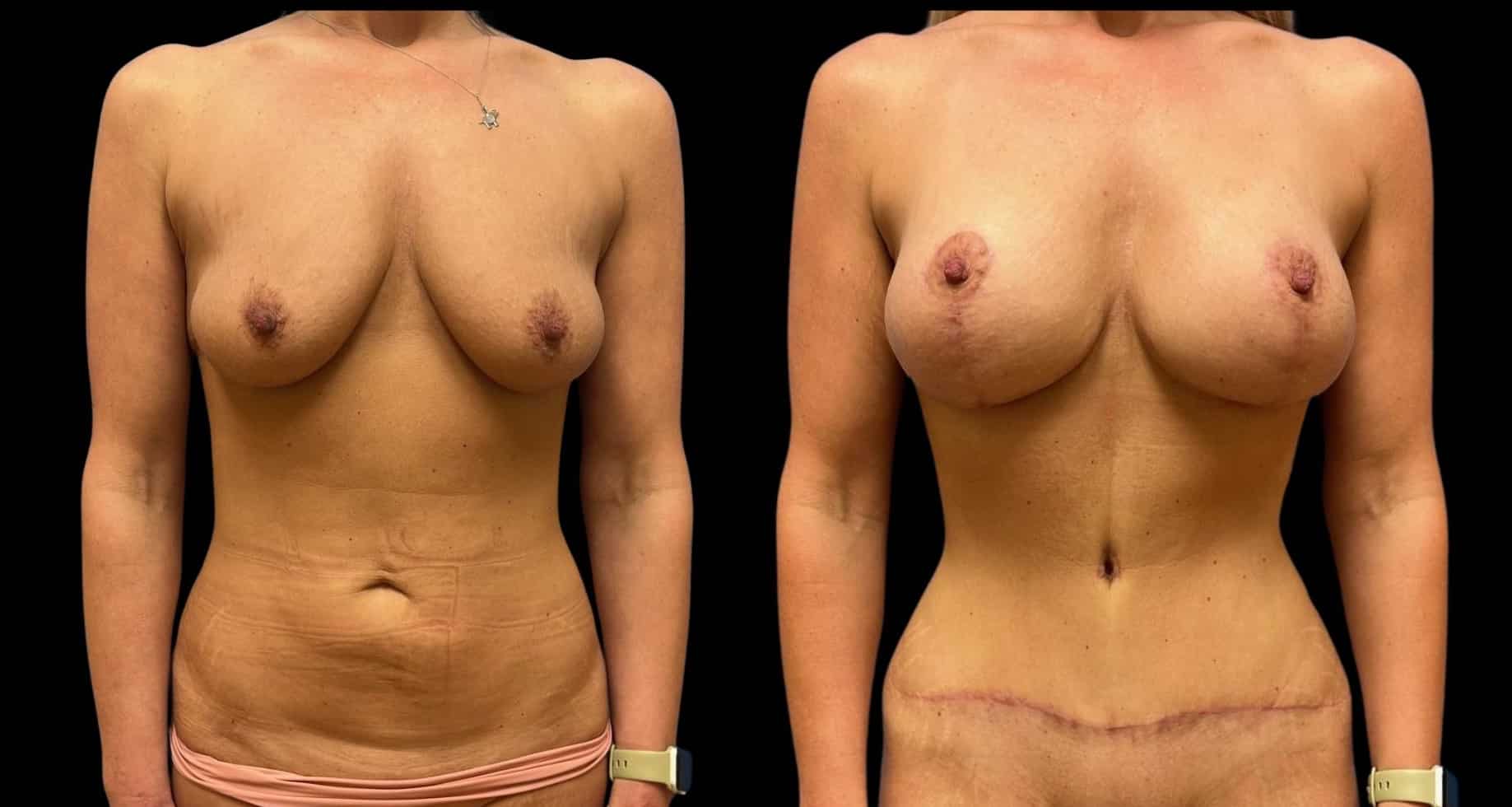 Before and After Image: Mommy Makeover
