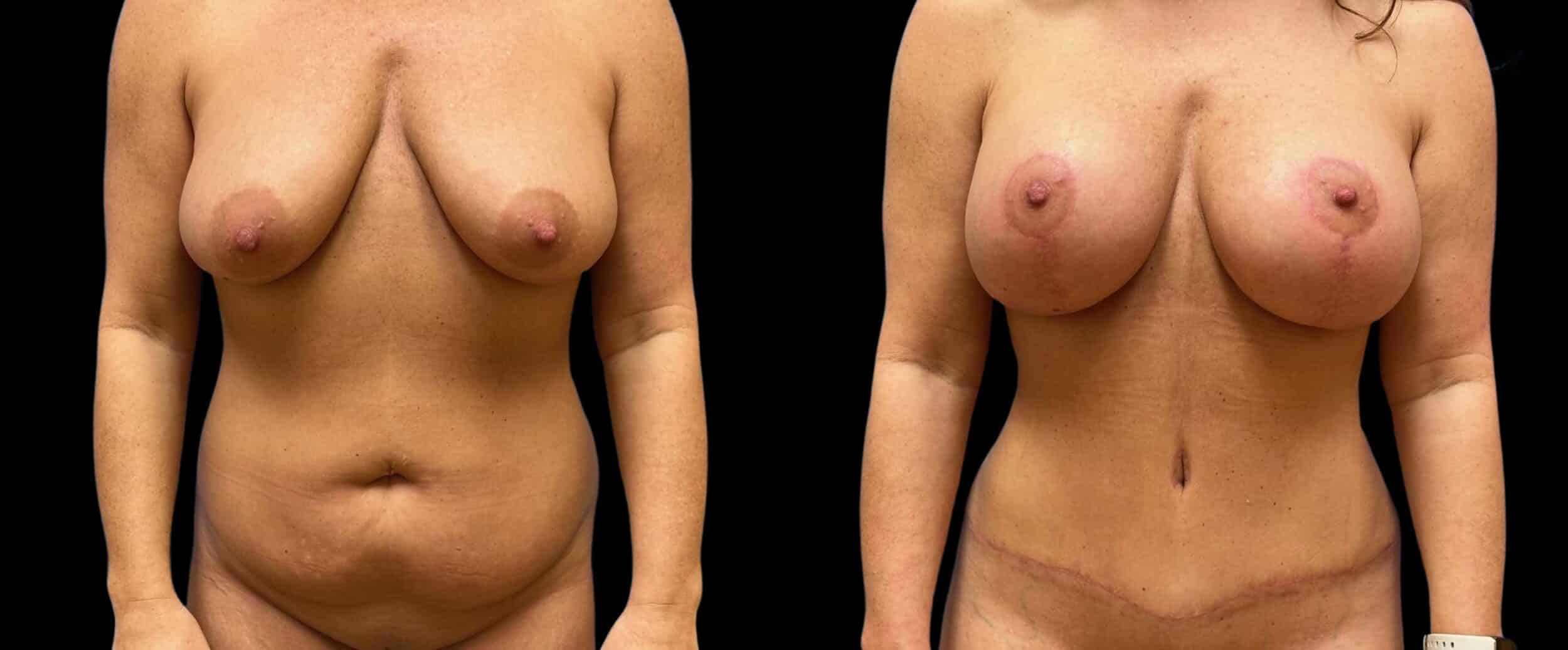 Before and After Image: Mommy Makeover - front