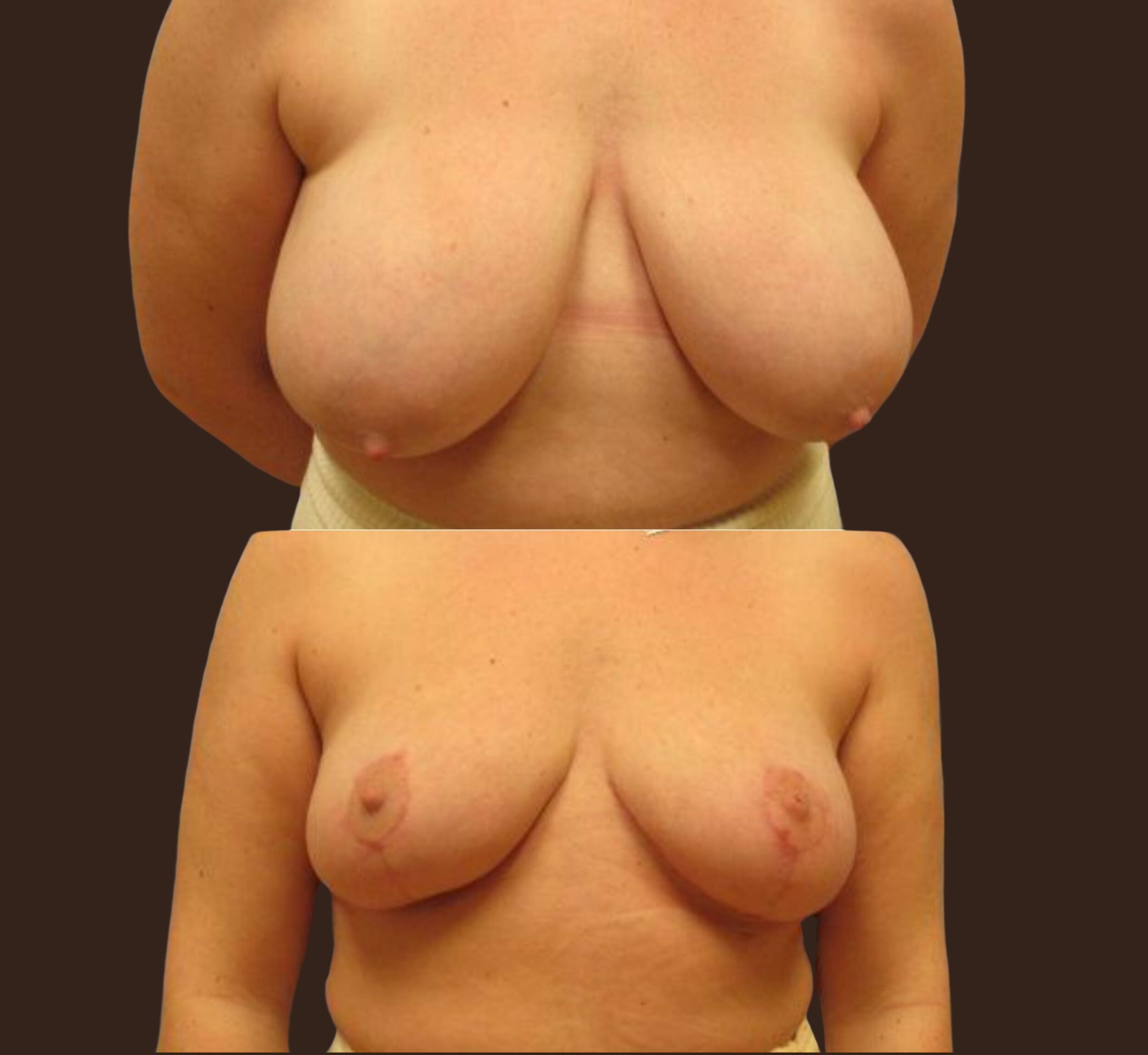 Before and After Image: Bilateral Breast Reduction - front