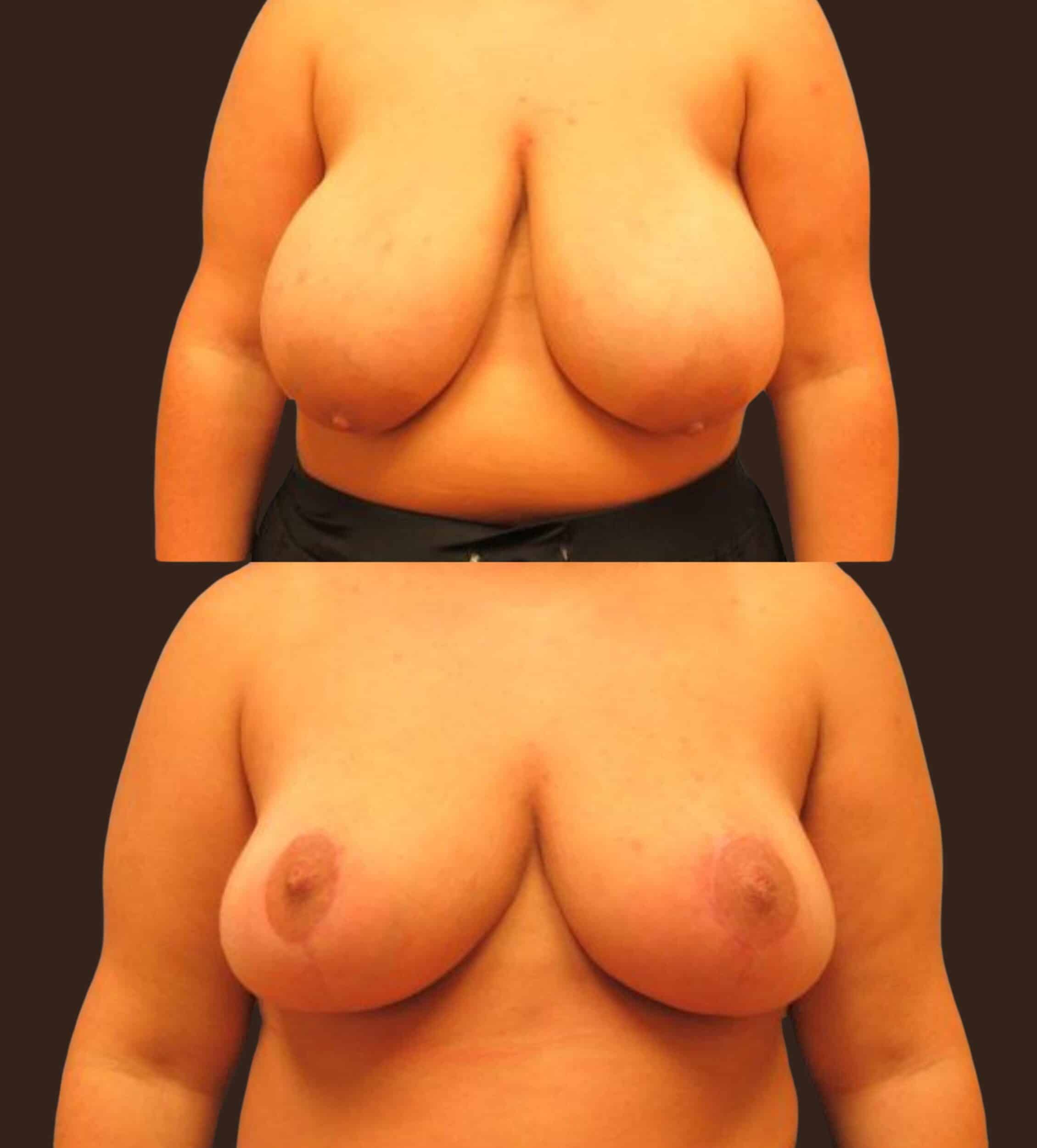 Before and After Image: Bilateral Breast Reduction - front