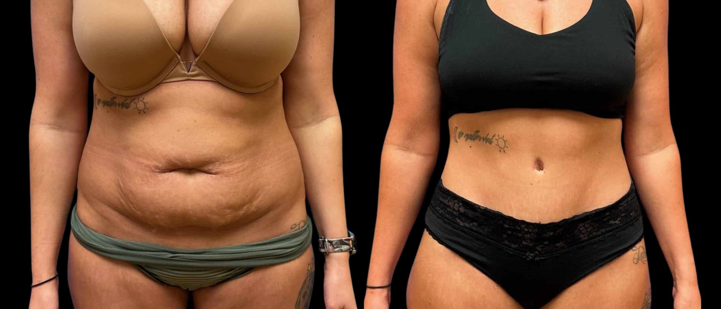 Before and After Image: Tummy Tuck - front