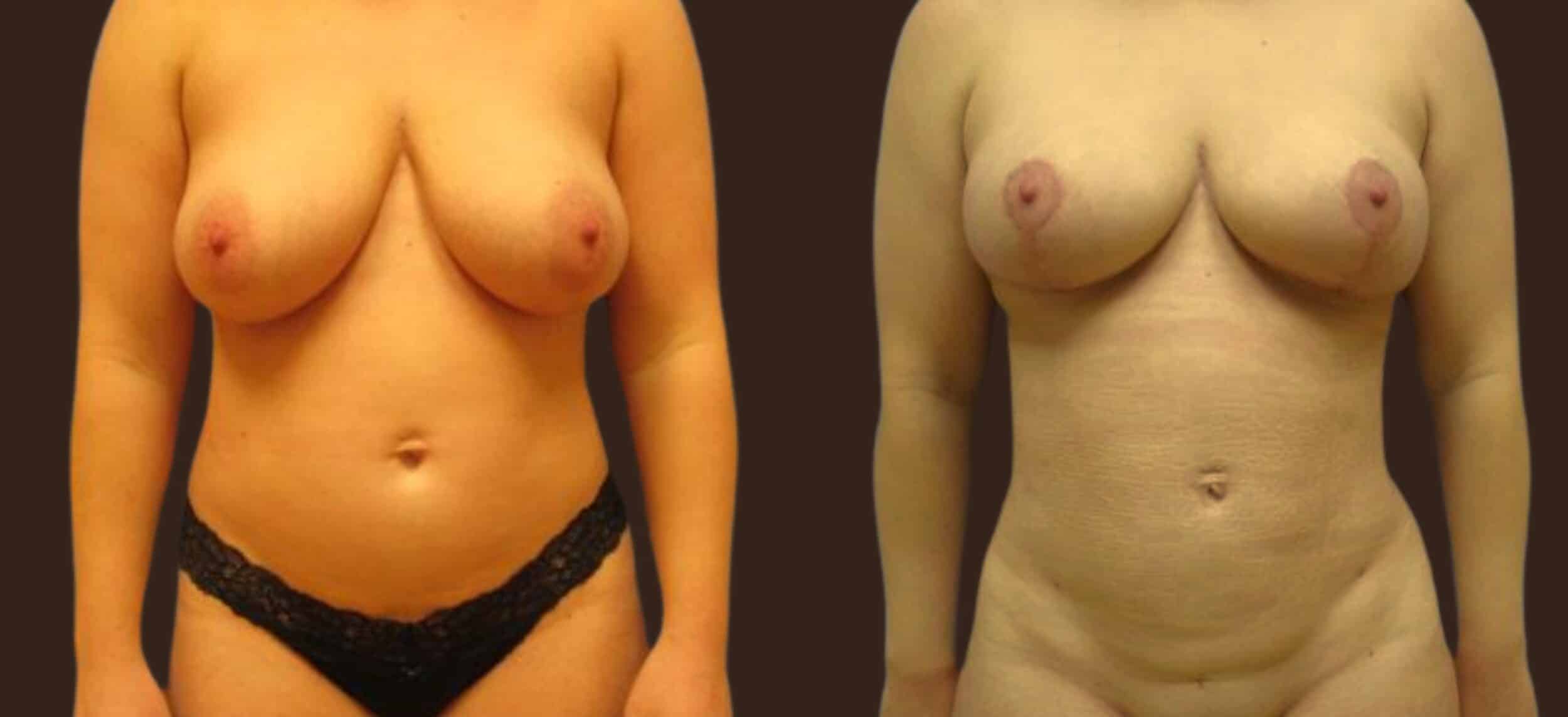 Before and After Image: Liposuction - front