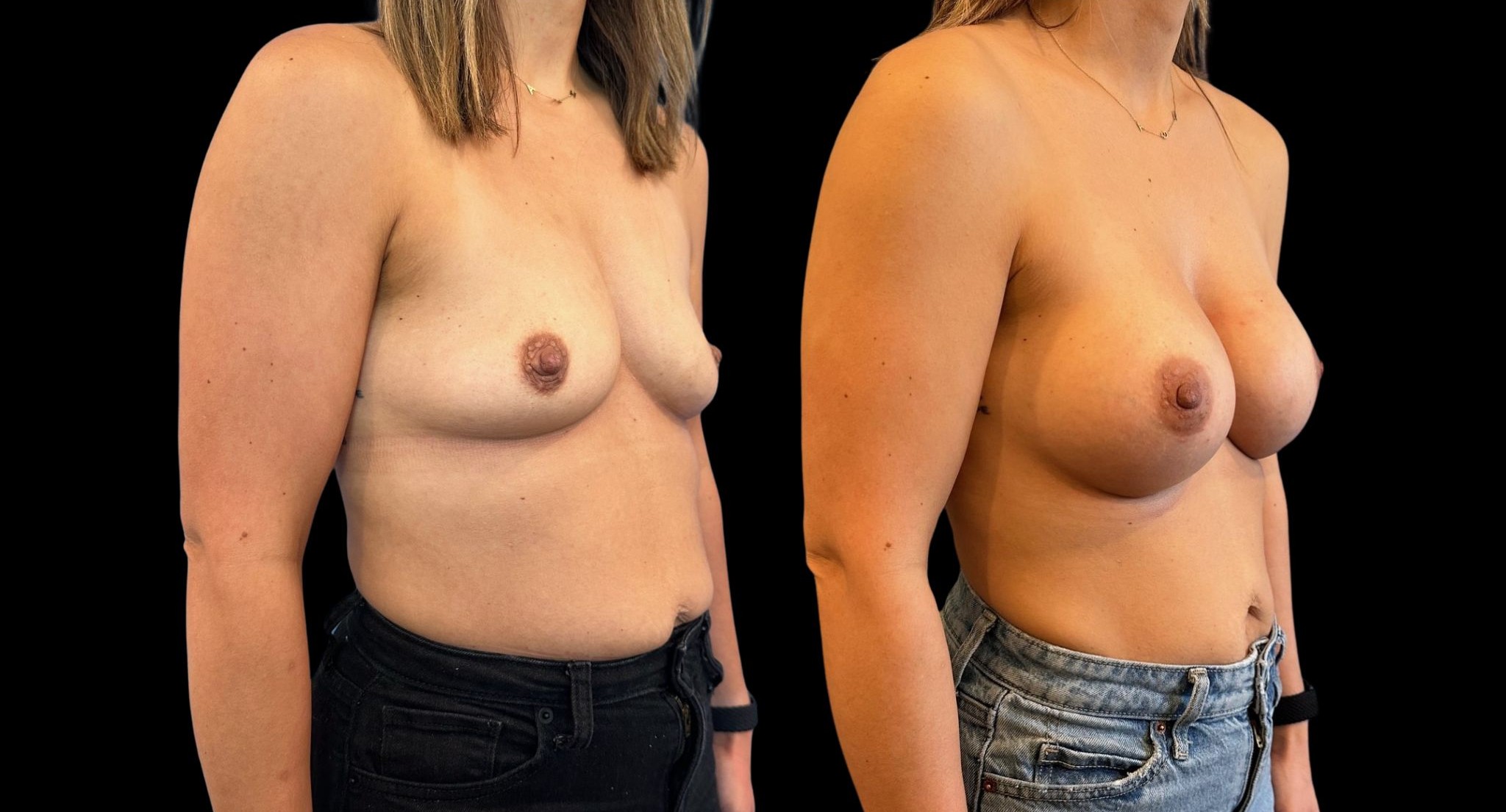 Before and After Image: Breast Augmentation - right-front-oblique