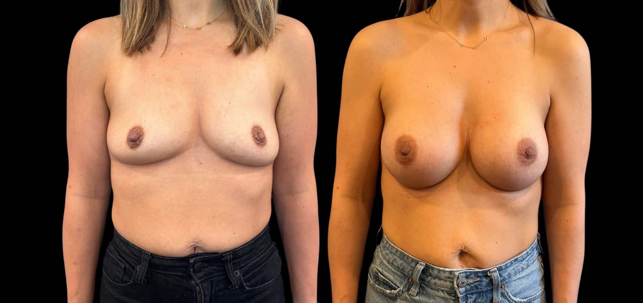 Before and After Image: Breast Augmentation - front