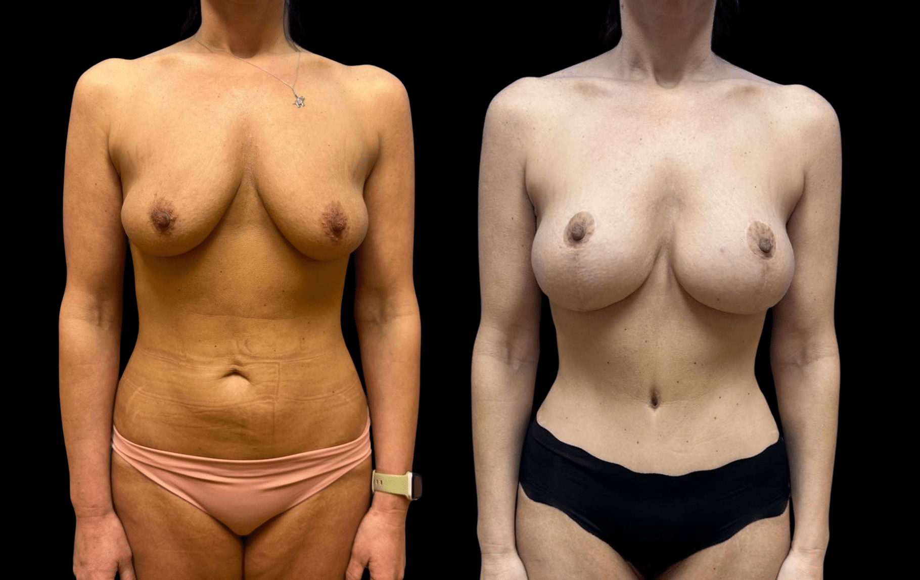 Before and After Image: Mommy Makeover