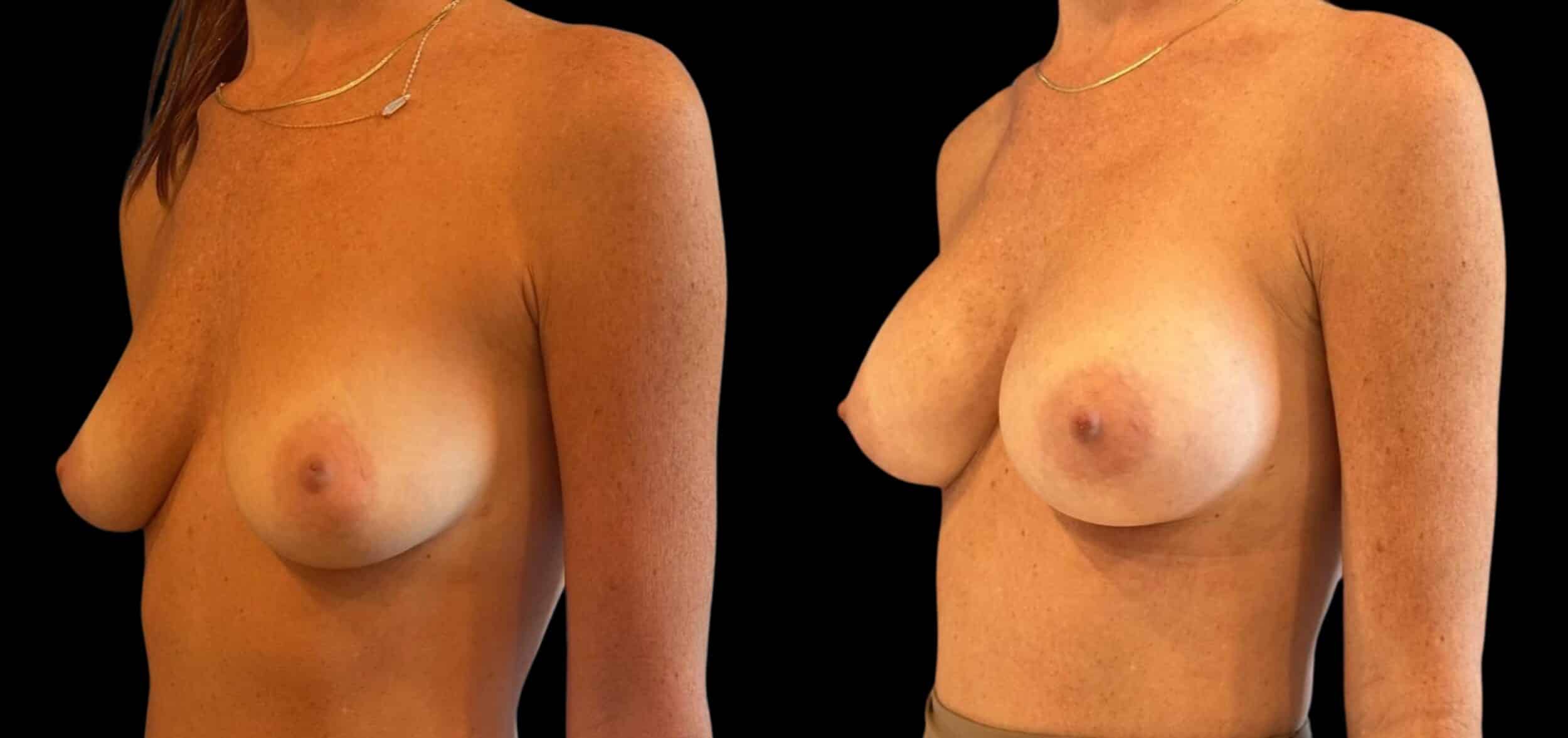 Before and After Image: Mommy Makeover - left-front-oblique