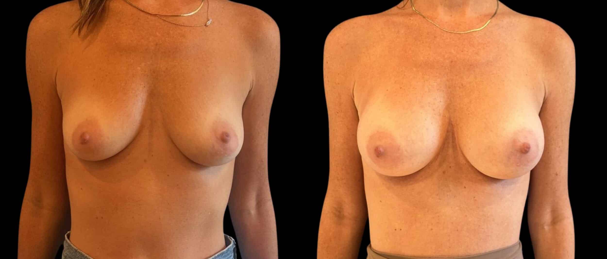 Before and After Image: Mommy Makeover - front